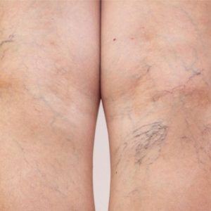bigstock-female-legs-with-varicose-vein-342125035_1_621x621