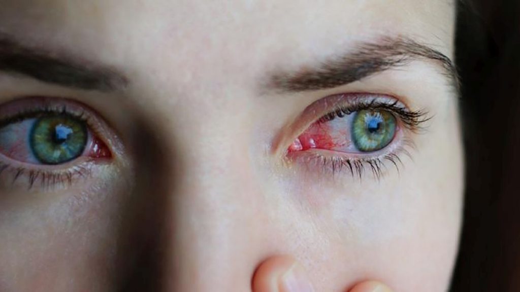 conjuntivitis-enfermedad
