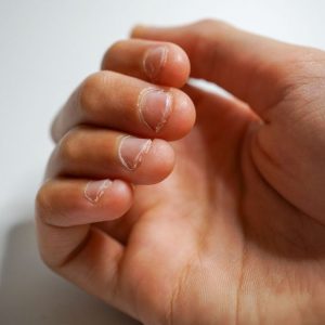 bigstock-boys-hand-with-chewed-fingerna-430563059_1_621x621