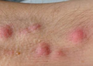 Hidradenitis_Supurativa-350x250