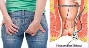 tratar-las-hemorroides