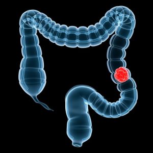 bigstock-colon-cancer-3304506_1_621x621