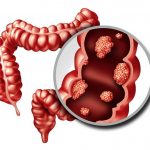 “El cáncer de colon provoca 23 muertes por día que pueden prevenirse”