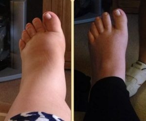 swollen-feet-4