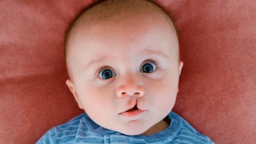 1010x567_labio-leporino-453332-192448