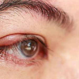 bigstock-right-upper-eye-lid-abscess-s-91580396_1_621x621