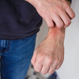 objetos-que-pueden-provocar-dermatitis-de-contacto_1_621x621