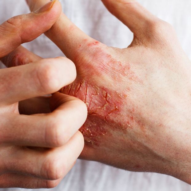 psoriasis-y-enfermedad-intestinal_1_621x621