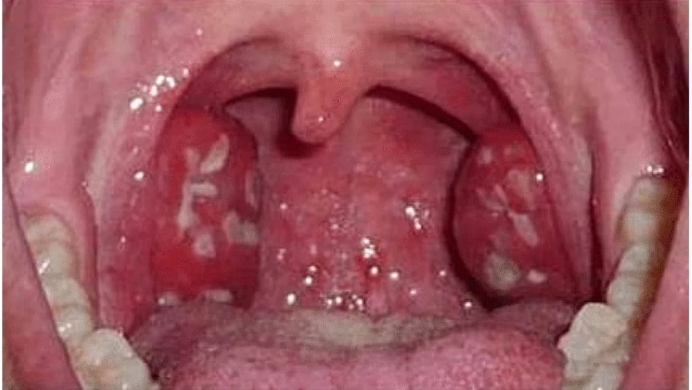 Streptococcus-pyogenes-3
