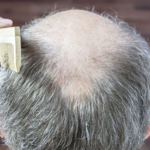bigstock-baldness-and-hair-of-an-aging-271226572_1_621x621