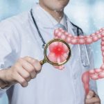 Los síntomas del cáncer de colon