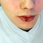 La sífilis aumentó en el país