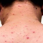 ¿Tengo que vacunarme contra el sarampión si ya tuve la enfermedad?