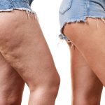 Lipedema: un problema estético y de salud