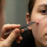 Las verrugas cutáneas: evitar los remedios caseros