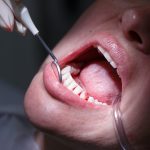 Por qué la salud bucal tiene menos cobertura de prepagas y obras sociales