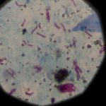 Preocupa la tuberculosis cuyo contagio no para de crecer