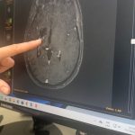 ACV en jóvenes cada vez  más frecuentes
