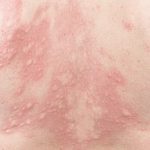 La alergia que aparece cuando te refrescas