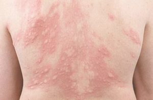 Urticaria-a-frigore