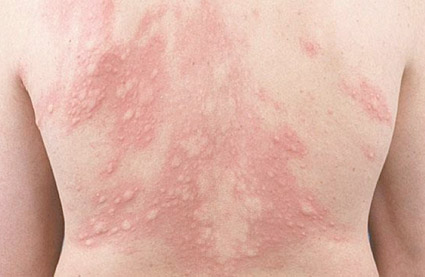 Urticaria-a-frigore