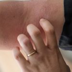 La dermatitis atópica