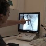 Colocaron un stent bioabsorbible en un bebé prematuro