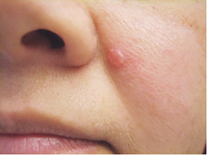 basal-cell-carcinoma-1-shiny-bump