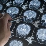 Células que protegen del Alzheimer