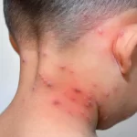 La varicela es infeccioca y sigue vigente