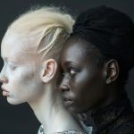 El drama de los albinos en Madagascar