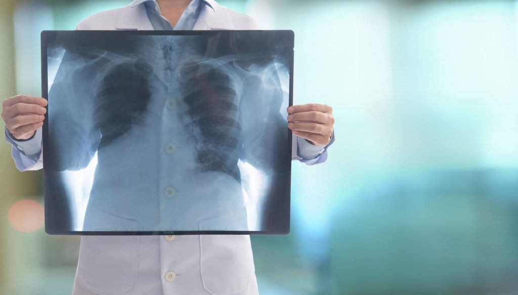 trombo-pulmonar-en-ancianos