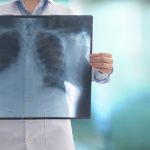 Trombosis pulmonar, una afección prevenible