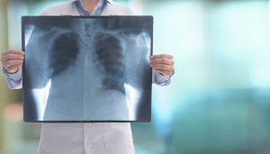trombo-pulmonar-en-ancianos